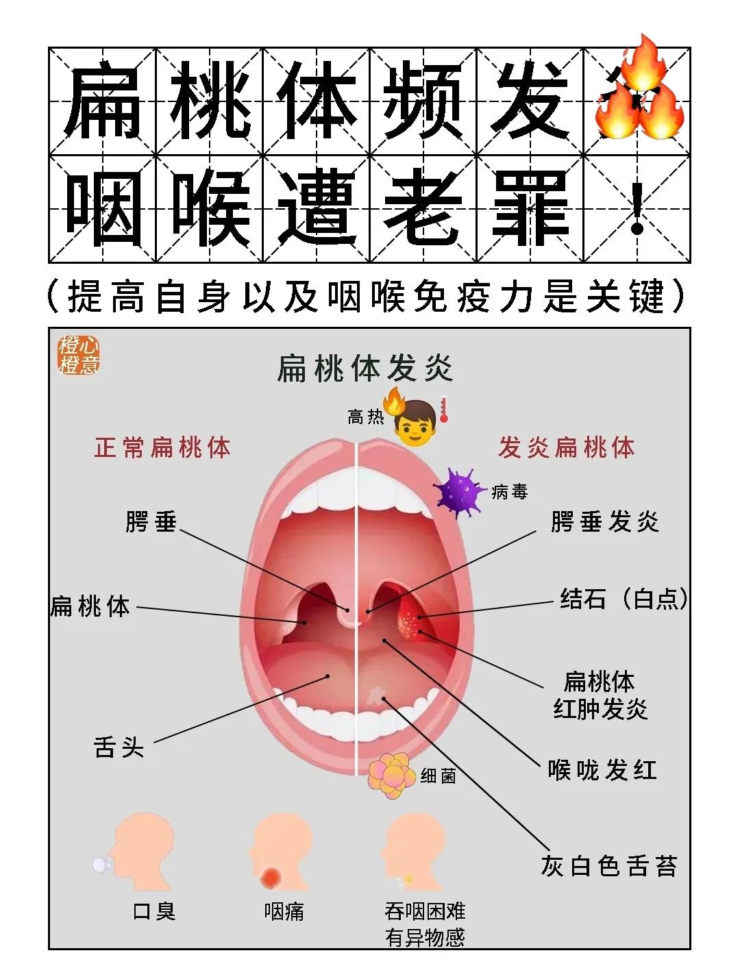儿童正常扁桃体高清图(儿童正常扁桃体高清图 肥大) 儿童正常扁桃体高清图(儿童正常扁桃体高清图 肥大)