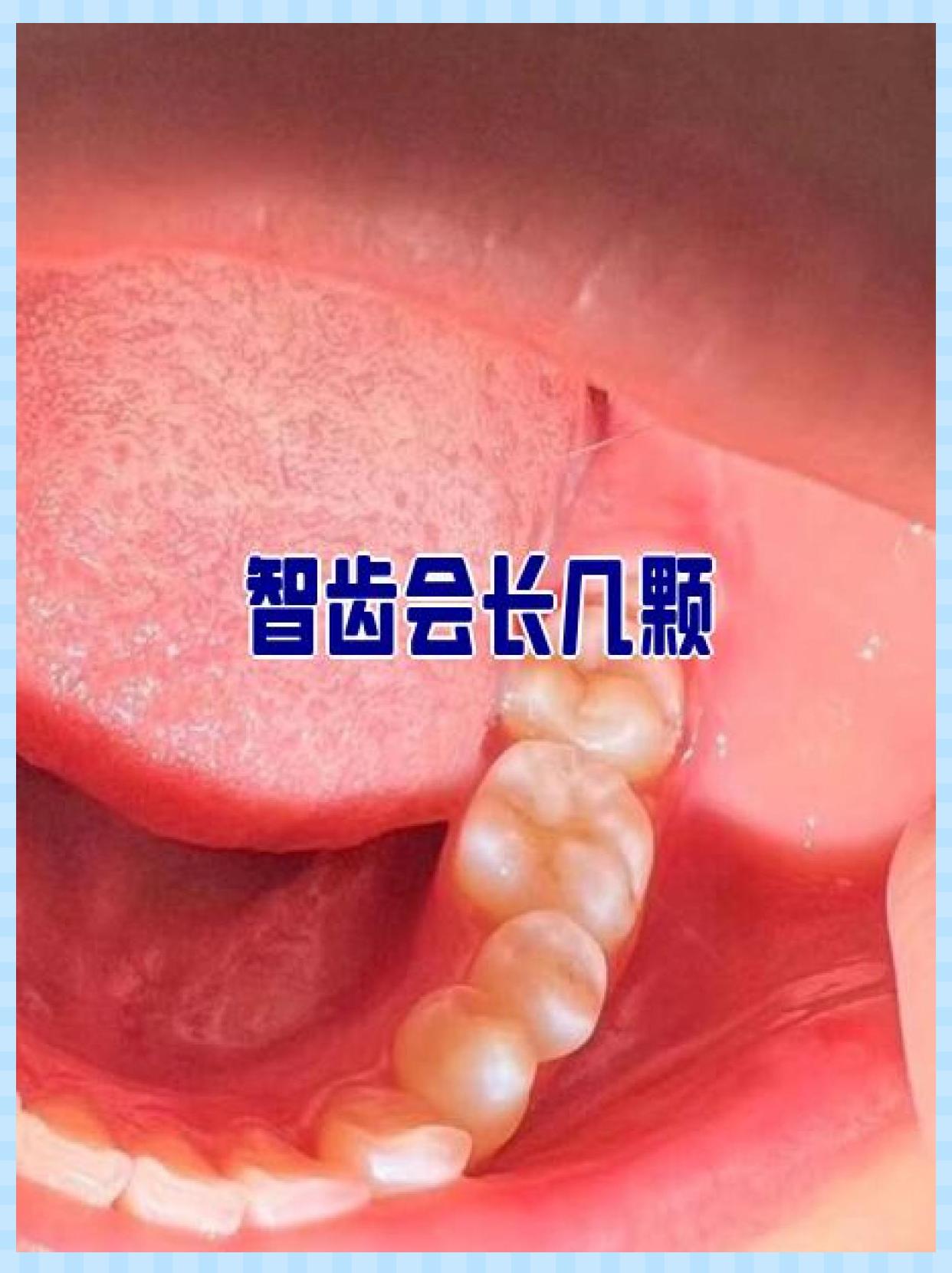 智齿的位置图片(智齿一定要拔掉吗) 智齿的位置图片(智齿一定要拔掉吗)
