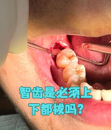 智齿的位置图片(智齿一定要拔掉吗) 智齿的位置图片(智齿一定要拔掉吗)