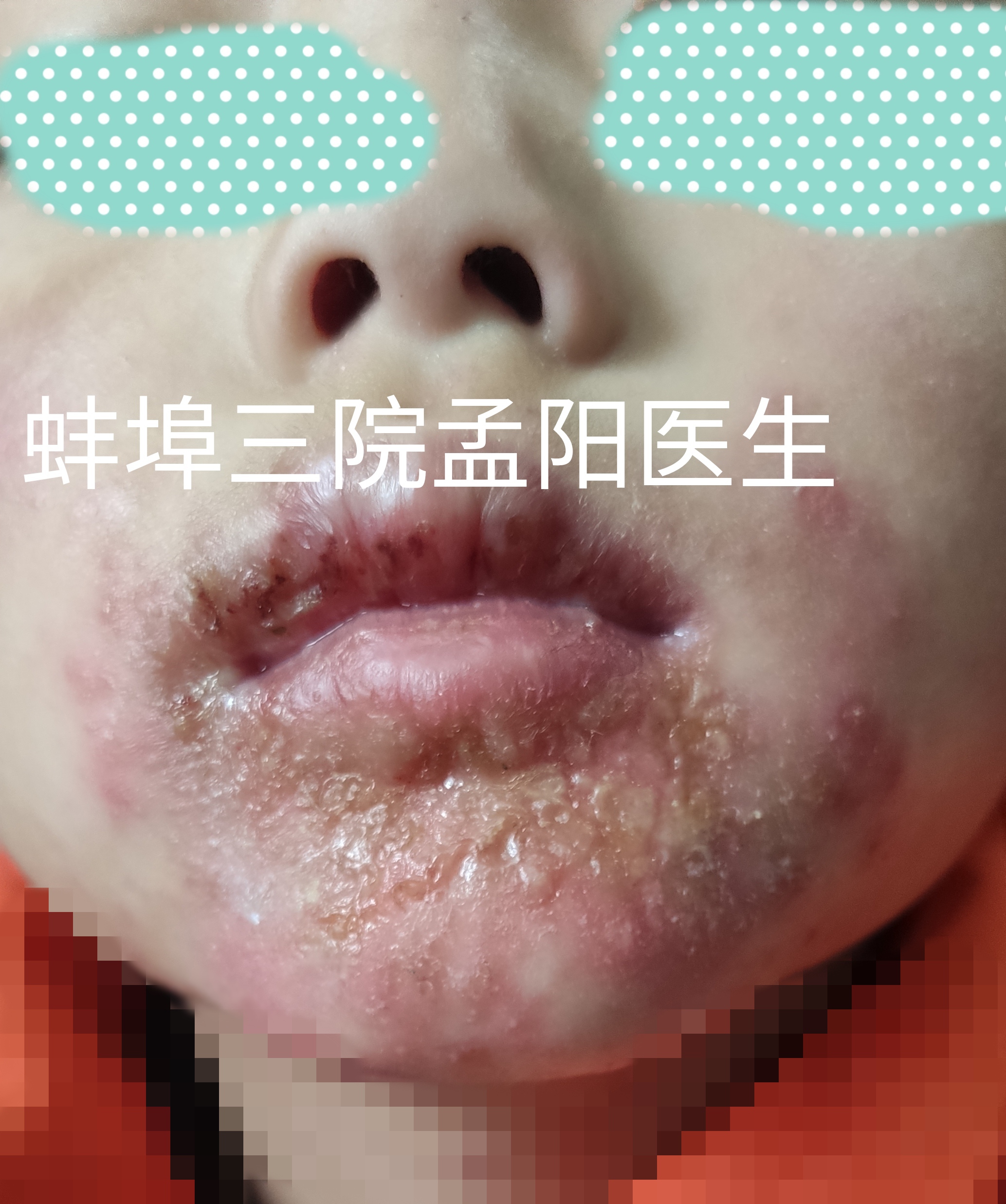 嘴巴周围长癣图片(嘴巴周围长癣是怎么回事)