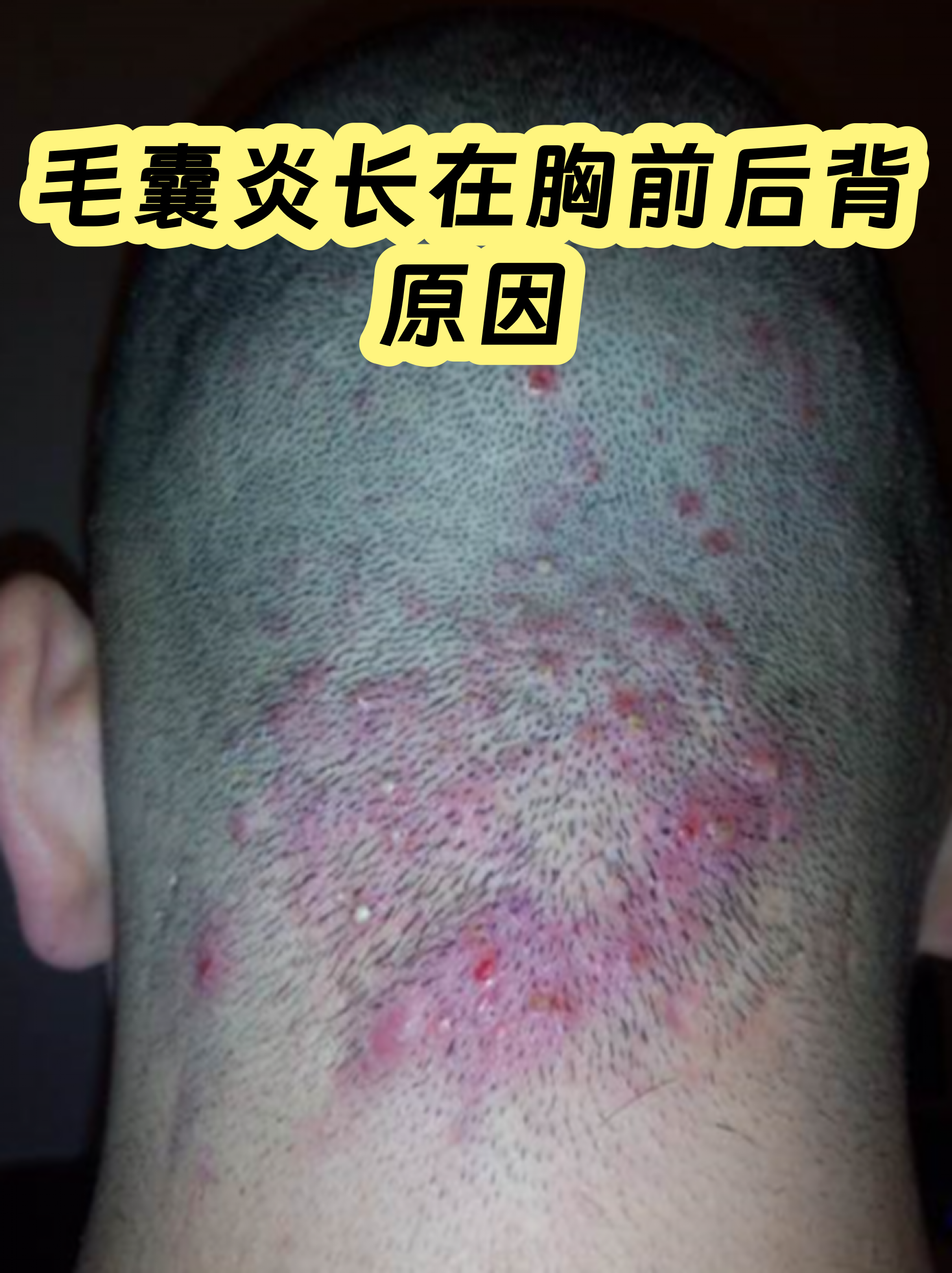 胸前毛囊炎真实图片(胸前毛囊炎疙瘩怎么消除) 胸前毛囊炎真实图片(胸前毛囊炎疙瘩怎么消除)