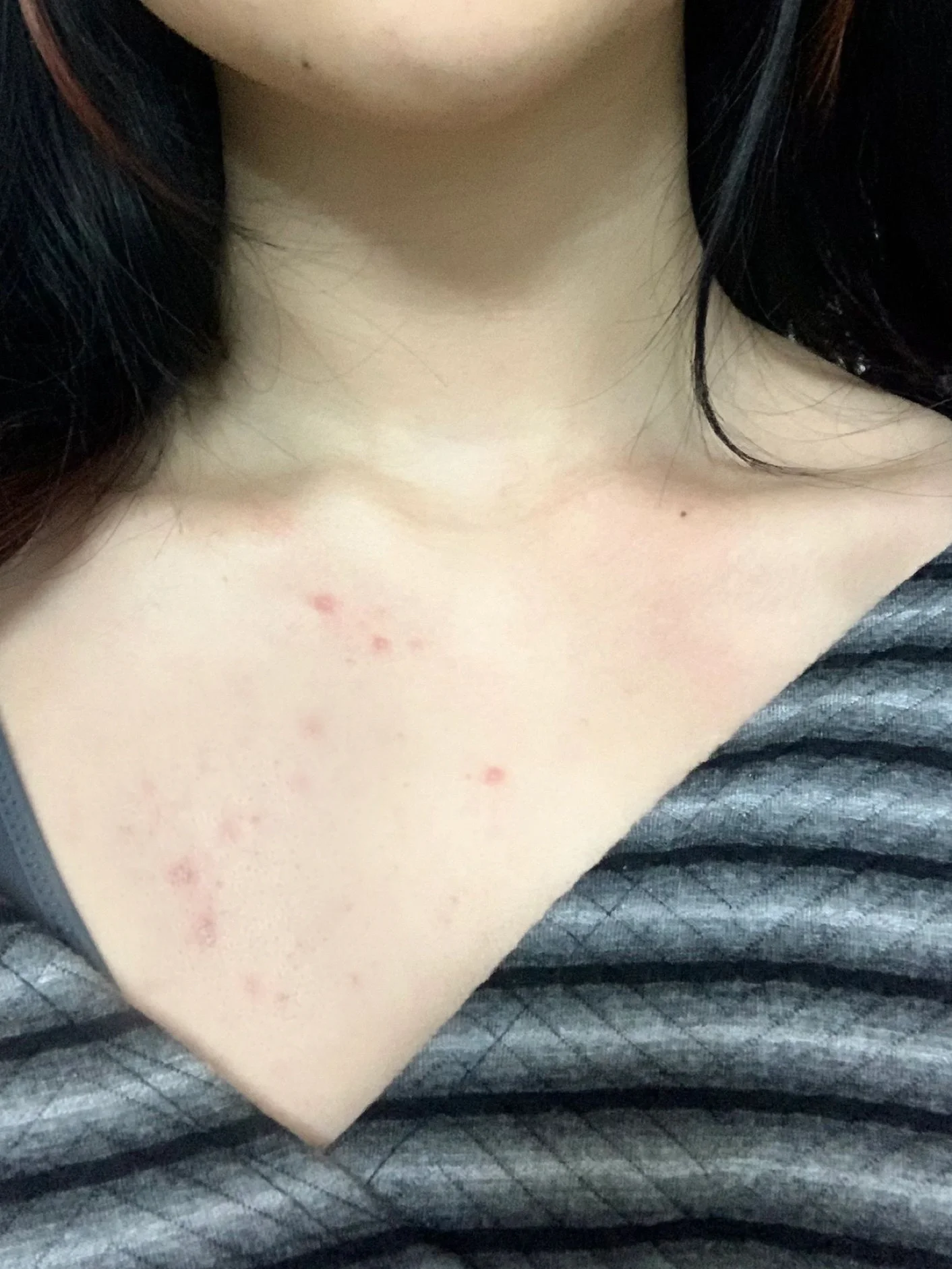 胸前毛囊炎真实图片(胸前毛囊炎疙瘩怎么消除) 胸前毛囊炎真实图片(胸前毛囊炎疙瘩怎么消除)