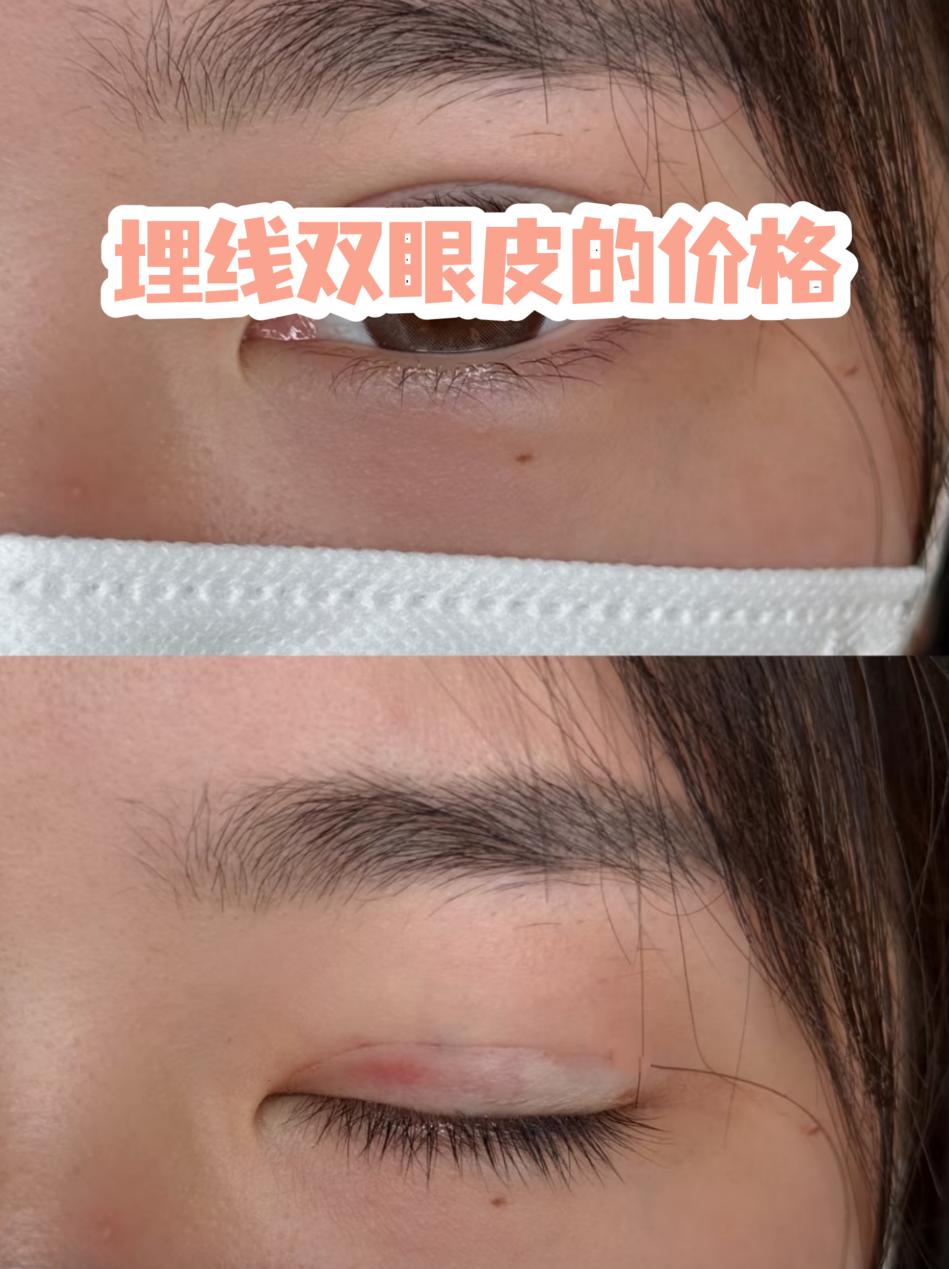 割双眼皮大概多少钱(什么年龄割双眼皮最好) 割双眼皮大概多少钱(什么年龄割双眼皮最好)