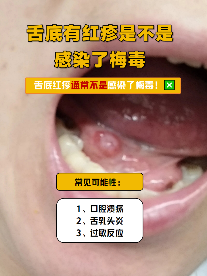 舌头底下溃疡图片(舌头底下溃疡怎么治好得快) 舌头底下溃疡图片(舌头底下溃疡怎么治好得快)