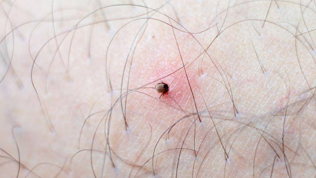 女性得阴虱症状图片(女性得阴虱症状图片大全) 女性得阴虱症状图片(女性得阴虱症状图片大全)