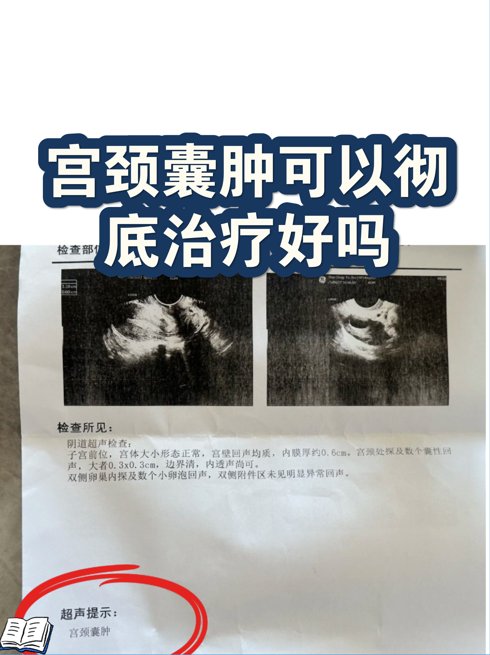 宫颈囊肿图片大全(宫颈囊肿图片是什么样 清晰图片) 宫颈囊肿图片大全(宫颈囊肿图片是什么样 清晰图片)