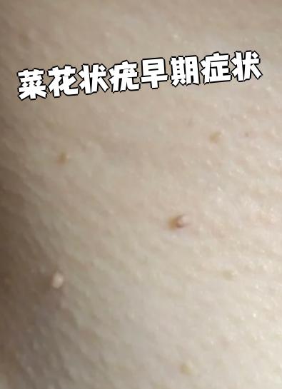 瘊子早期症状图片(瘊子早期症状图片大全) 瘊子早期症状图片(瘊子早期症状图片大全)