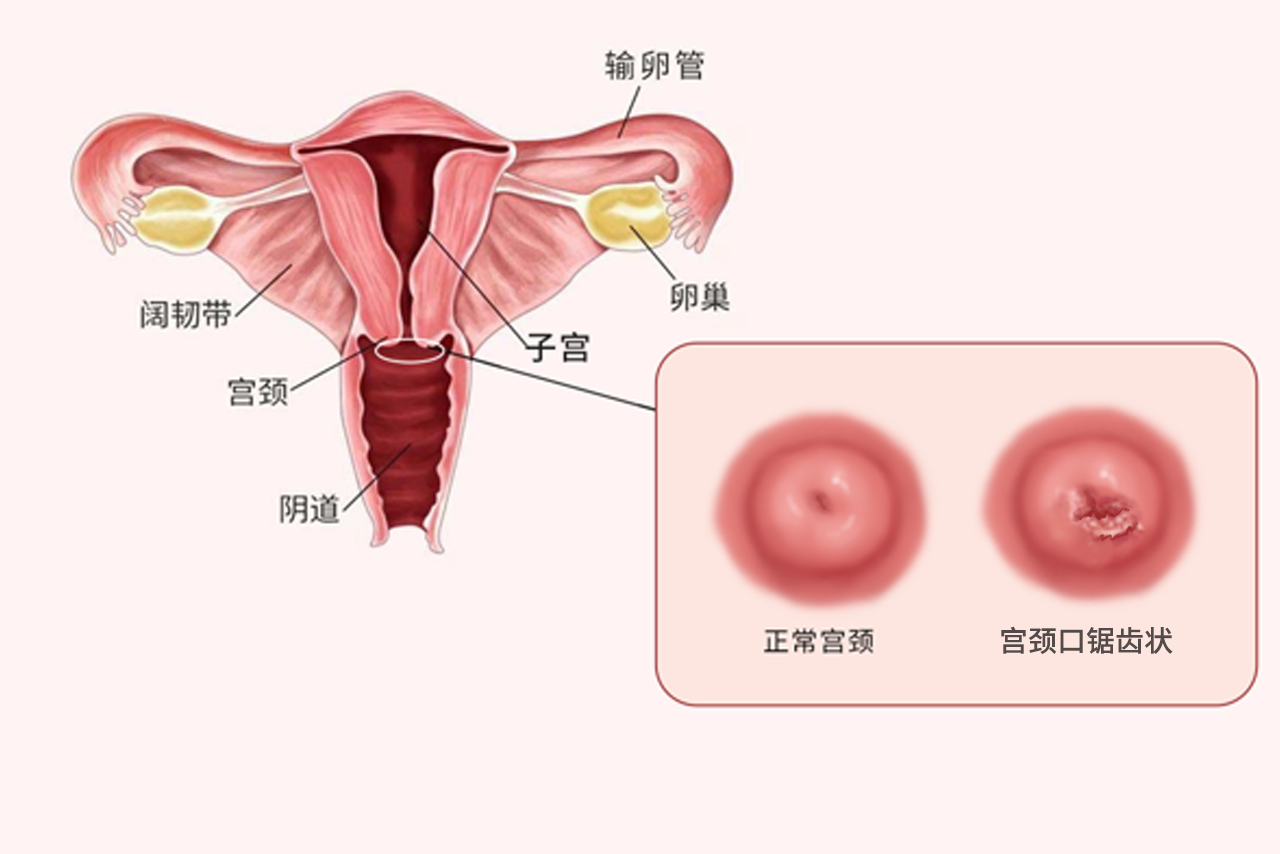 宫颈图(子宫宫颈图)