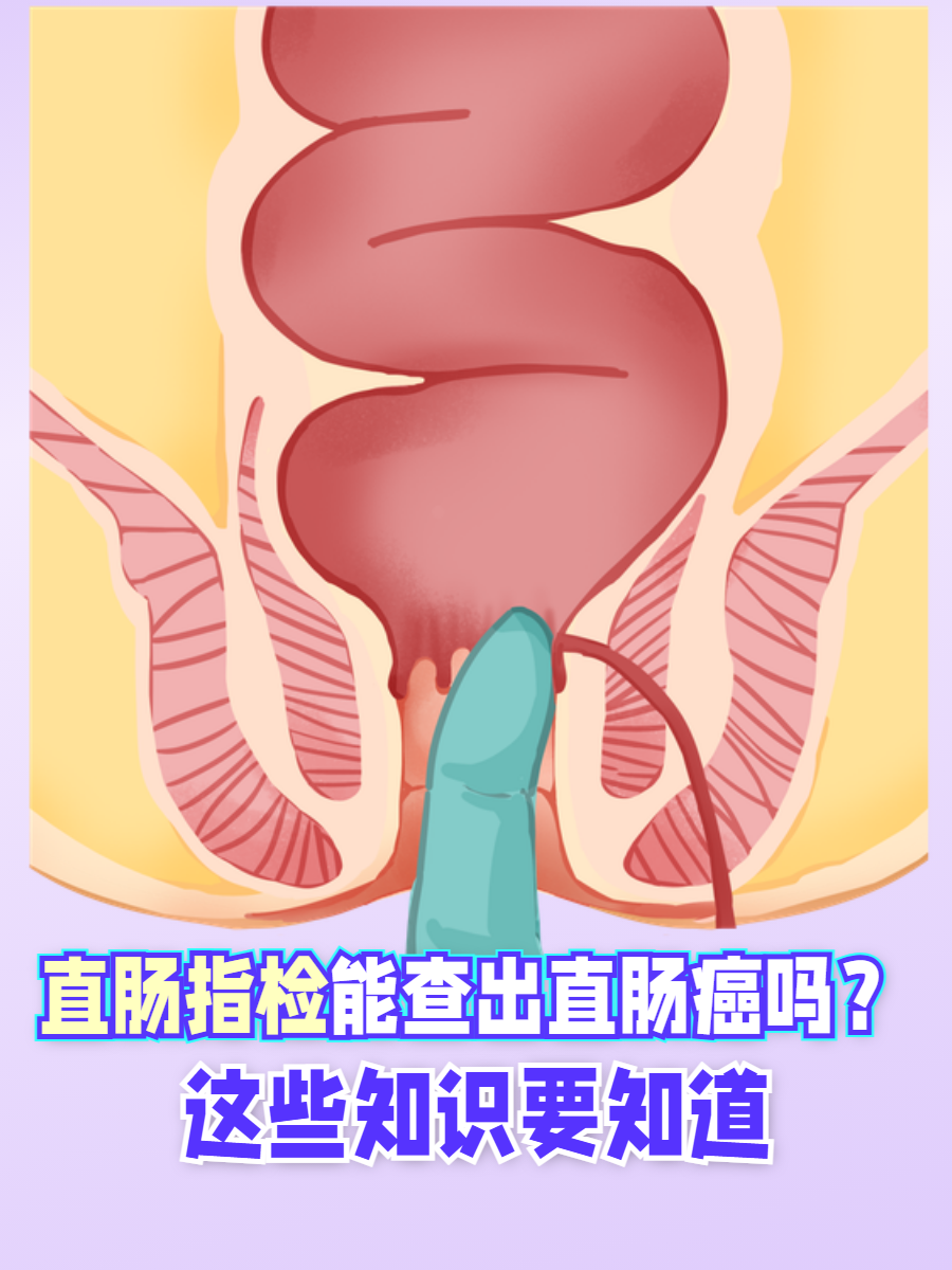 直肠癌肛门图片(直肠的位置清晰图) 直肠癌肛门图片(直肠的位置清晰图)
