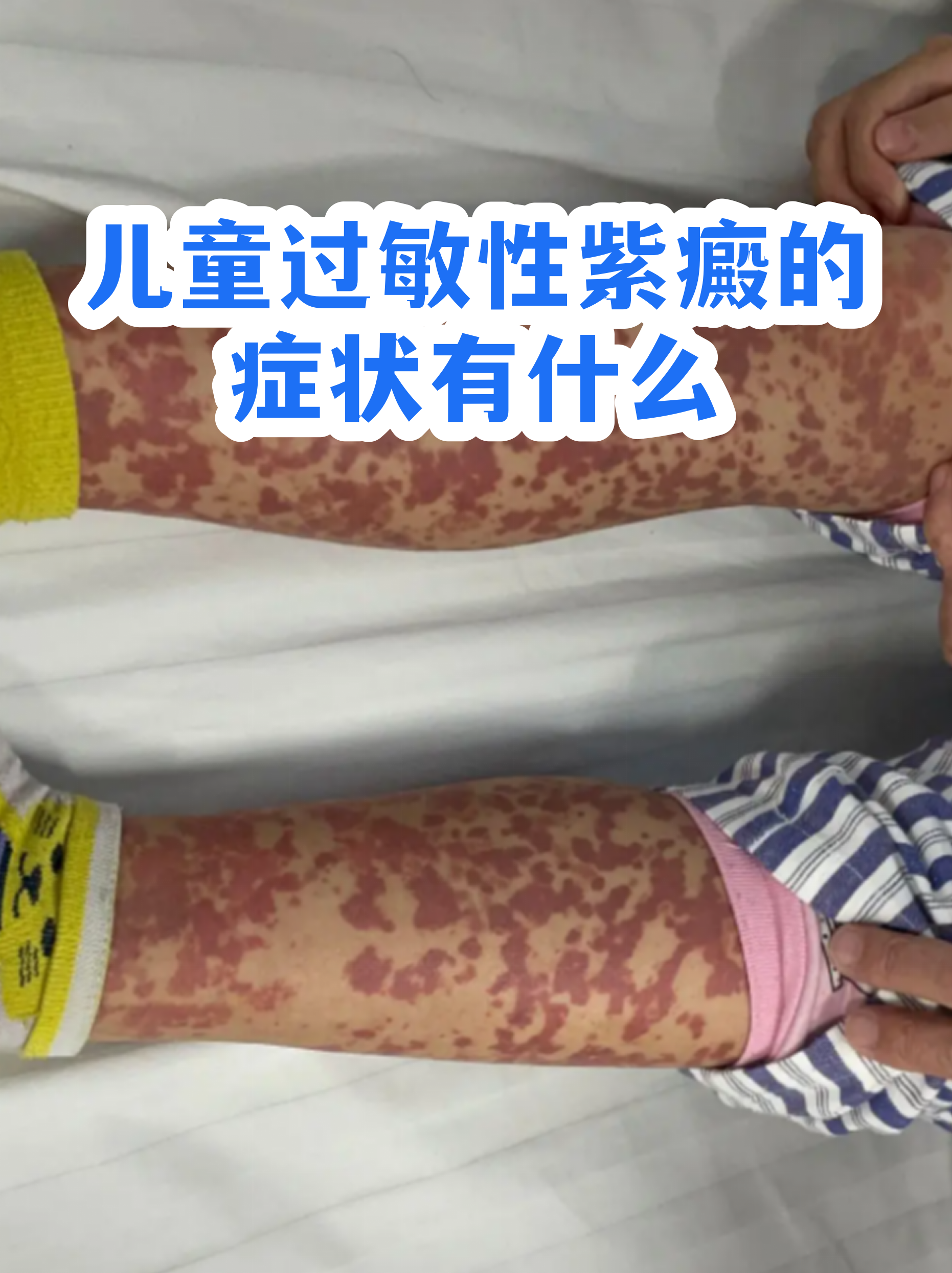 单纯紫癜图片(单纯性紫癜图片 治疗方法)