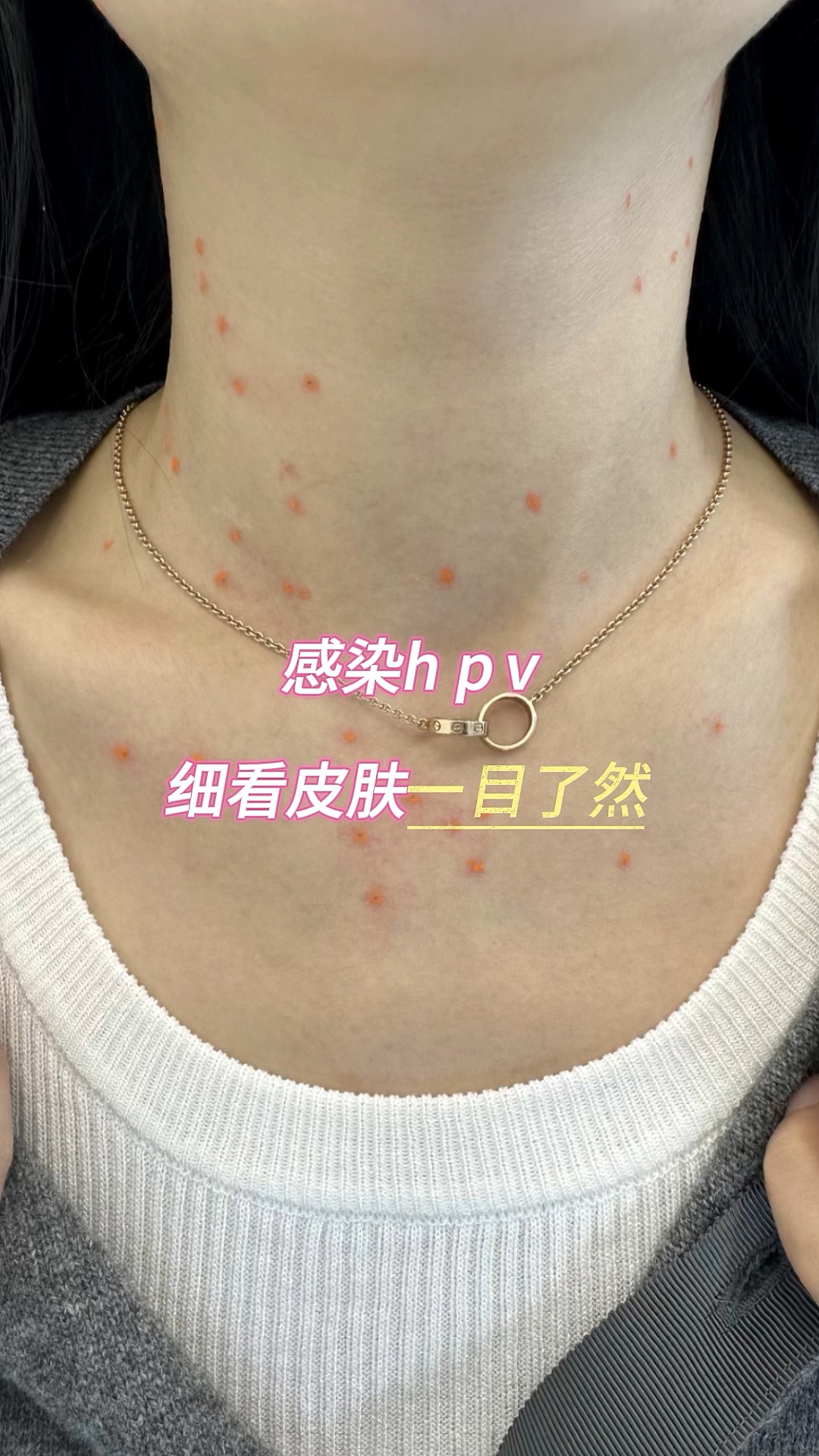 hpv是什么病是什么症状图片(hpv是什么病是什么症状图片大全)